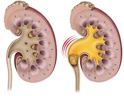 Kidney Stones Brisbane Urology Clinic