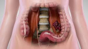 Pain in the pelvis or low in the belly. Location Of Pelvic Tumor Youtube