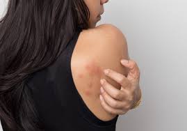 This disorder, or perhaps two disorders with the same clinical. Mi Okozza A Csalankiutest Happymed