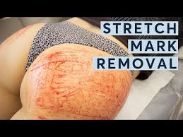 Fast absorbing and packed with skin nourishing essential fatty acids and vitamins. Stretch Mark Removal Pulse Light Clinic London