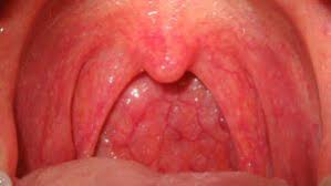 Image result for Mouth ulcers symptoms roof of the mouth