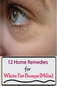 I've searched the internet and i've come up with things like whiteheads and milia but i don't think that's the case for me. Pin On Pin Tastic