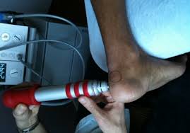 Mettre la zone douloureuse au repos pendant quelques jours. Se Soigner Grace Aux Ondes De Choc Radiales Valdemarne Fr