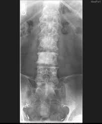 The spread may be very rapid, as in this case, where it took only eight months since … Medpix Case Metastatic Prostate Cancer Blastic