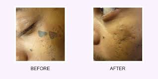 This video shares insight into the cost of tattoo removal. I Want My Tattoo Removed I Regret My Tattoo