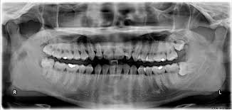 Fdi World Dental Federation Notation Wikipedia