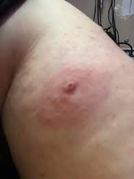 Image result for wolf spider bite skin