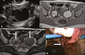 Endometriosis is a condition where tissue similar to the lining of the womb starts to grow in other places, such as the ovaries and fallopian tubes. Scielo Brasil Ruptured Endometrioma Main Imaging Findings Ruptured Endometrioma Main Imaging Findings