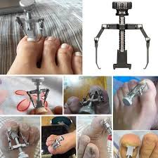Tuscom Ingrown Toe Nail Recover Correction Tool Pedicure Toenail Fixer Foot Nail Care Walmart Com Ingrown Toe Nail Toe Nails Feet Nails