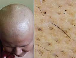 Understanding how hair follicle drug tests work and how long marijuana can be detected will help you make the best choices should you need to pass a hair follicle drug test. Jaypeedigital Ebook Reader