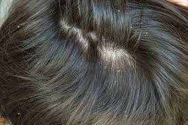 Image result for white scabs on the head in children