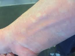 Check spelling or type a new query. Manchas Rojas En La Piel Que Aparecen Y Desaparecen Causas Y Tratamiento