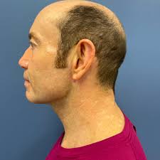 🌟 5-Star Review from One of Our 5-Star Patients! 🌟 We're thrilled to  share the success story of this incredible 60-year-old gentleman who  underwent a neck lift and liposuction to his abdomen