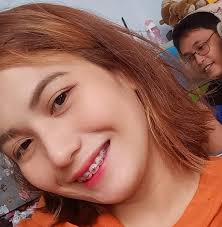 Namumuti, nangangati at nagpapatsi-patsi ang balat hanggang sa kumalat na  ito sa buong katawan. Ganito ang nararanasan ng mga taong may "vitiligo."  Ano nga ba ang sakit na ito at may solusyon