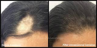 At evexias, we offer a variety of treatments for hair loss or shedding, which may include: Treatment Of Alopecia Areata Village Dermatology