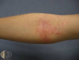 There is currently no cure for this condition, although there are treatments that may help to alleviate the itchy symptoms. Eczema 14 Cases Dermnet Nz