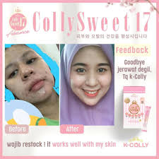 Be the first to review kcolly sweet 17 cancel reply. Cara Alami Hilangkan Bekas Jerawat Di Wajah Cara Minum K Colly