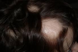 Anthralin cream for alopecia topical vitamin d cream for psoriasis anthralin minoxidil Alopecia Areata Dermatology Advisor
