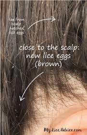 Image result for lice vs nits
