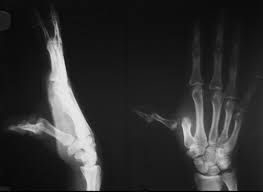 Image result for DIP Dislocation