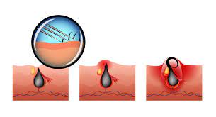 And, it really is difficult to find out the actual reason. 8 Ways How To Prevent Get Rid Of Ingrown Facial Hair