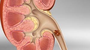 Download now batu ginjal 1 5 kg berhasil dikeluarkan dari tubuh pria. Awas Inilah Gejala Penyakit Batu Ginjal Yang Sering Diabaikan Tribunnews Com Mobile