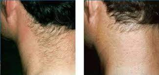 Laser hair removal is more effective than other hair removal treatments on the market because it targets the follicle rather than only the hair shaft. Before And After Laser Hair Removal From Back Of Neck Laser Hair Removal Hair Removal Women Best Hair Removal Products