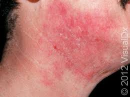 Image result for Atopic eczema atopic dermatitis