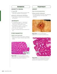 Image result for Gardner Sendromu