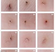 Armpit lumps can have many different causes, such as Ingrown Hair Account Tweezist Is Your New Guilty Pleasure Express Digest