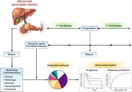 In the vast majority of cases, symptoms only develop after pancreatic cancer has grown and begun to spread. Refining Classification Of Pancreatic Cancer Subtypes To Improve Clinical Care Gastroenterology