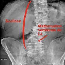 Pour les neurochirurgiens français et pour l'agence nationale d'accréditation et d'evaluation en santé (anaes) l'arthrodèse lombaire est une technique dont les indications ne sont pas clairement définies en. Scoliose De L Adulte Que Faire Espace Francilien Du Rachis