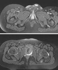 The most common symptom is pelvic pain. Mri Of The Proximal Sciatic Nerve A Axial Fat Suppressed T2 Weighted Download Scientific Diagram