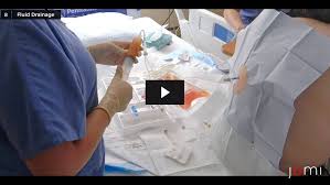 Image result for Thoracentesis