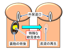 傍外尿道口嚢胞: 包茎と包茎手術