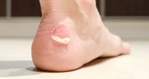 Blisters between toes are common to both running and walking activities. Blisters Signs Causes Types Treatment Prevention