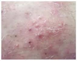 It can also be painful, but its pain does not resemble the distinctive burning pain of herpes. How To Tell Genital Herpes Apart From Other Skin Conditions