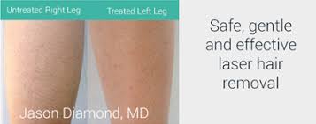 Yp canada provides extensive contact listings for in and near the grande prairie, alberta area. Laser Hair Removal Using Diolaze Xl