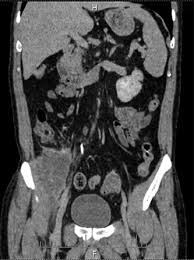 Microscopic anatomy of skeletal muscle. Coronal Ct Image Revealed Large Abscess Involving Right Iliacus Muscle Download Scientific Diagram