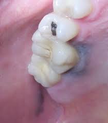 Typical for an amalgam tattoo. Amalgam Tattoo Exodontia