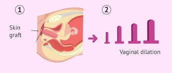 Affected women commonly do not have menstrual periods due to the absent uterus. What Is Mrkh Syndrome Causes Symptoms Treatment