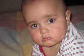 Coats' disease, when the eye has an odd appearance