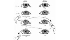 Normal Pupil Size For Perrla Perrla Eyes