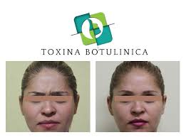 Toxina Botulínica preventiva #xeomeen #maxilofacialmty Cita de valoración  Online https://www.doctoralia.com.mx/nelly-ruth-limon -garcia/cirujano-maxilofacial/nuevo-leon