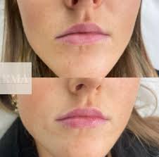 Rhianna May Aesthetics 💉👩🏼‍⚕️ (@rhiannamayaesthetics) • Instagram photos  and videos