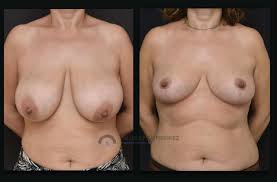 Fotos antes y después reducción de pecho por mamoplastia