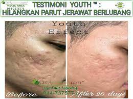 Hilangkan parut jerawat dengan cara yang sebenar. Testimoni Hilangkan Parut Jerawat Berlubang Selepas 20 Hari Dengan Skincare Youth Coach Bisnes Coach Detox Kurus Coach Penyusuan Susu Ibu Mentor Bisnes Pengedar Shaklee Pengedar Youth Pengedar Vivix 011 17547669