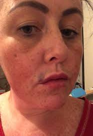 My lips exploded with pus after £60 botched fillers pierced a blood vessel  and left me permanently disfigured