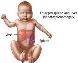 Gaucher S Disease Types Symptoms And Treatments