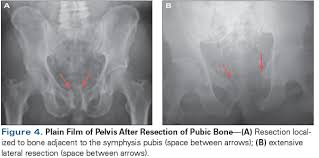 In most cases, blood in the urine (called hematuria) is the first sign of bladder cancer. Pubic Bone Osteomyelitis And Pubosymphyseal Urinary Fistula A Poorly Recognized Complication In Prostate Cancer Survivors